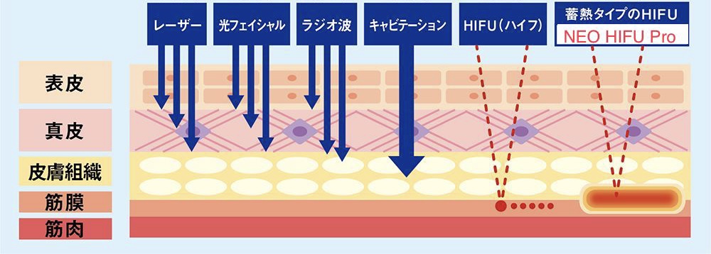 ハイフ身体&フェイシャル用 カートリッジ5つ付きの+spbgp44.ru